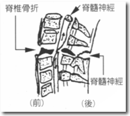 脊髓損傷說明圖